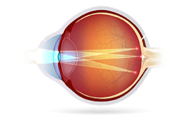 Astigmatism image