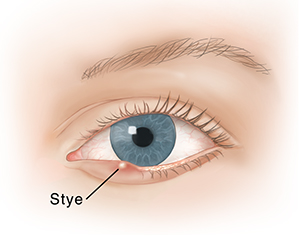 Eye stye