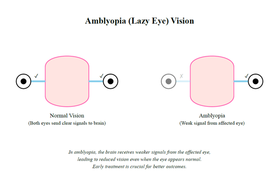 Lazy eye and LASIK