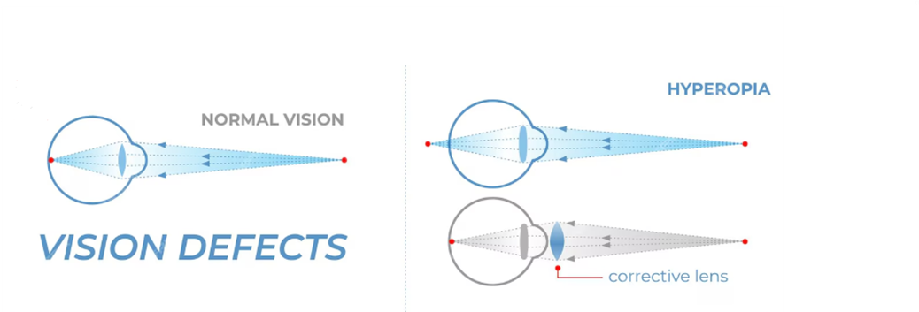 Refractive error 