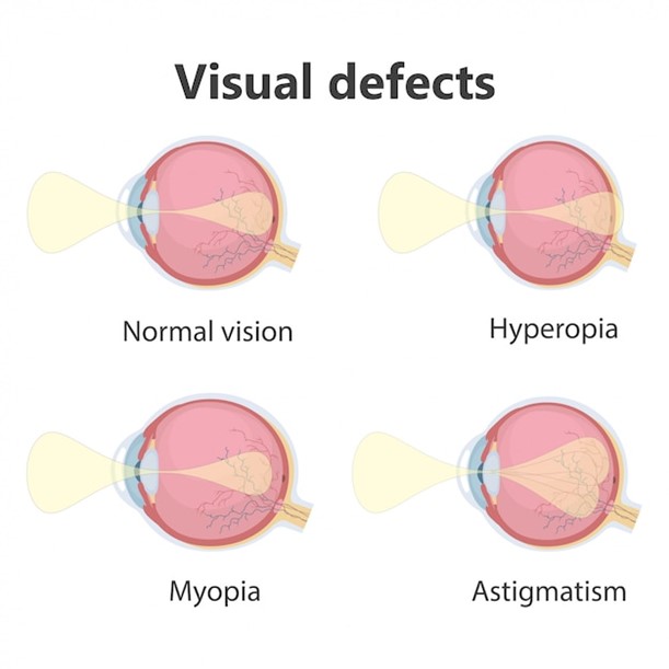 Correcting Refractive Errors with LASIK